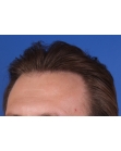 After Hair Transplant&nbsp;2 Sessions (Areas)